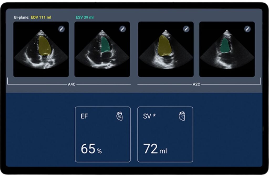 Kosmos AI-assisted Ejection Fraction Workflow
